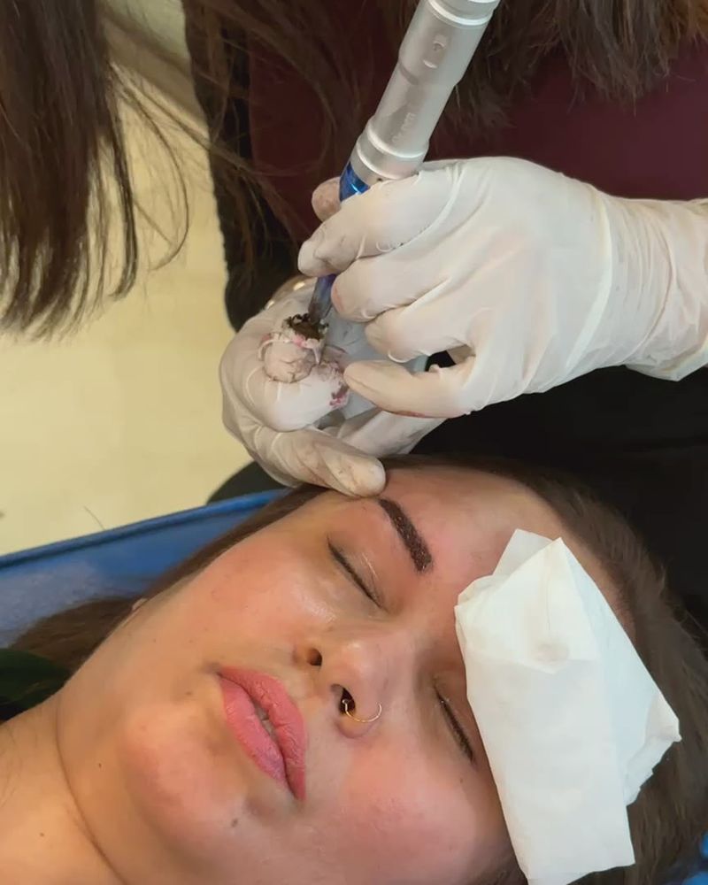 Close-up of a derma pen pass with protective gauze